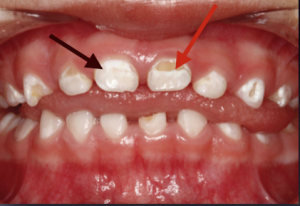 decalcification in baby teeth