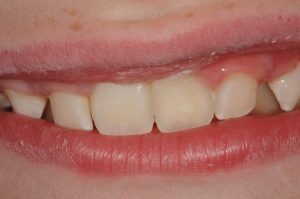 decalcification in baby teeth