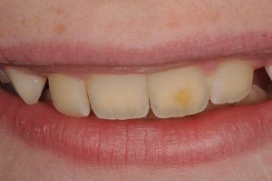 Brown Stains On Teeth Child Teethwalls