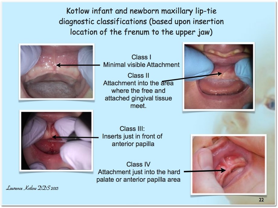 Lip Tie in Babies: Effects, Correction, Feeding Help